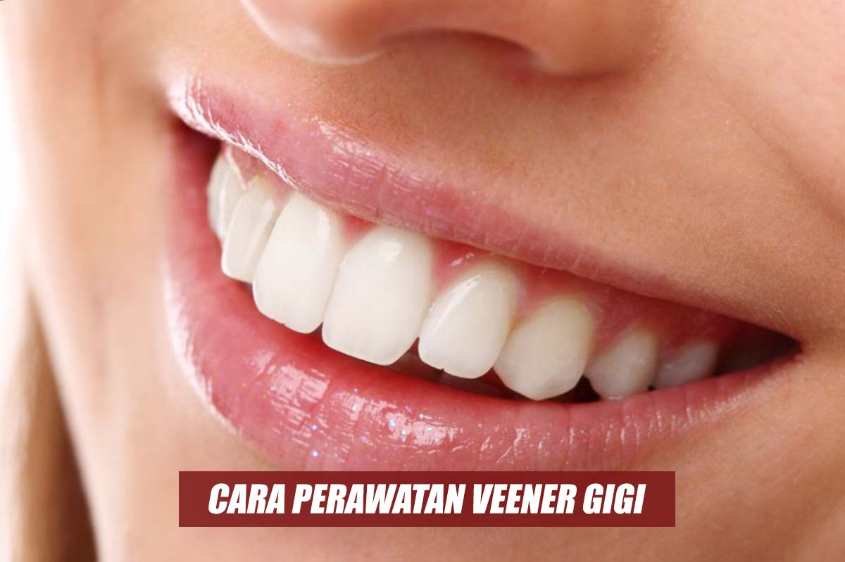 Bingung Melakukan Perawatan Veener Gigi? Simak Begini Cara Merawat Veener yang Tepat