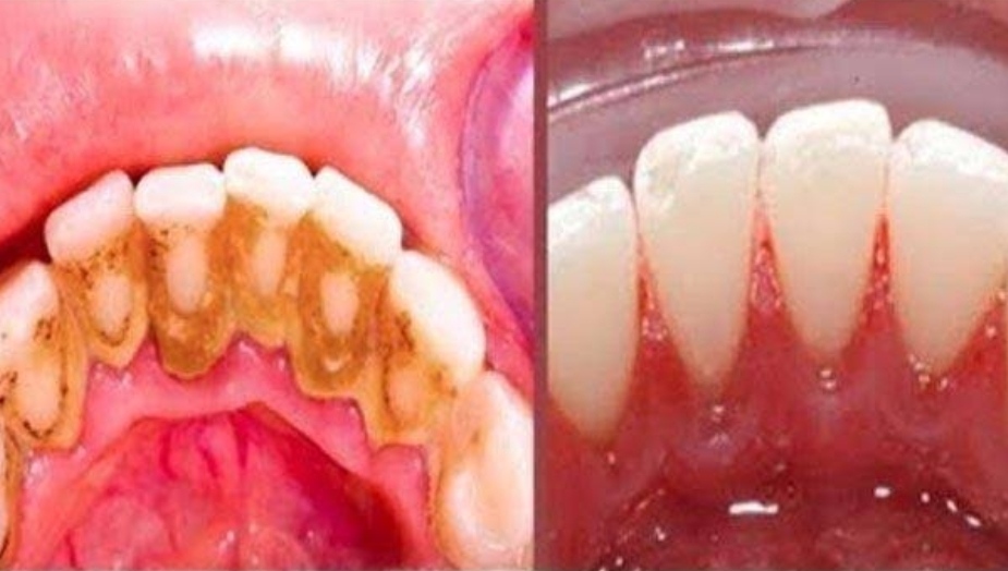 Karang Gigi Membandel Bikin Kamu Nggak Percaya Diri? Ini Tips Menghilangkan Karang Gigi yang Benar