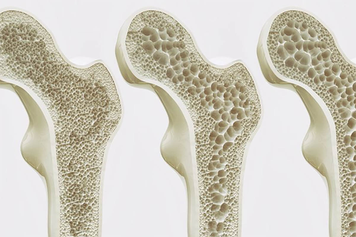 Awas Jangan Salah Paham, Inilah Perbedaan Pengapuran Tulang dan Pengeroposan Tulang yang Perlu Diketahui