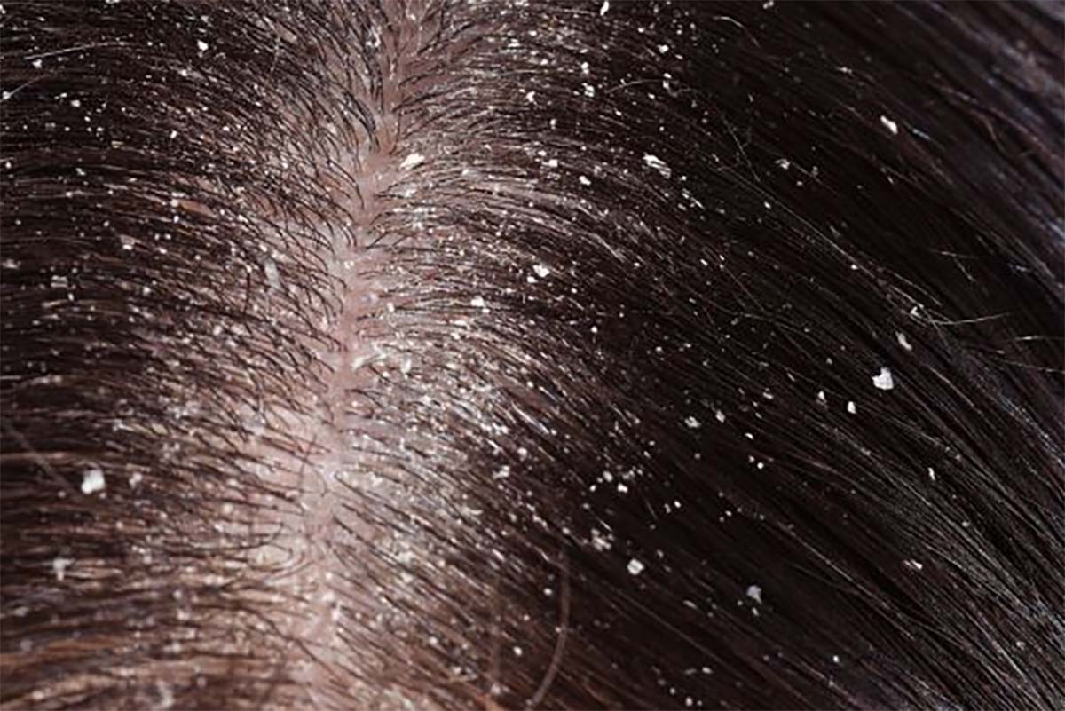 Ternyata Ini Penyebab Ketombe Pada Rambut yang Susah Hilang, Penyebabnya Jarang Disadari
