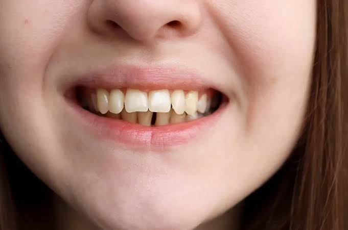 Faktor yang Membuat Bentuk Gigi Berubah Maju ke Depan