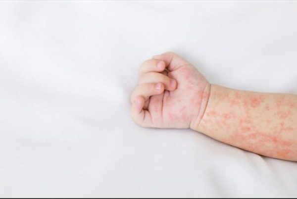 Orang Tua Harus Paham Tanda-Tanda Campak, Segera Ambil Tindakan