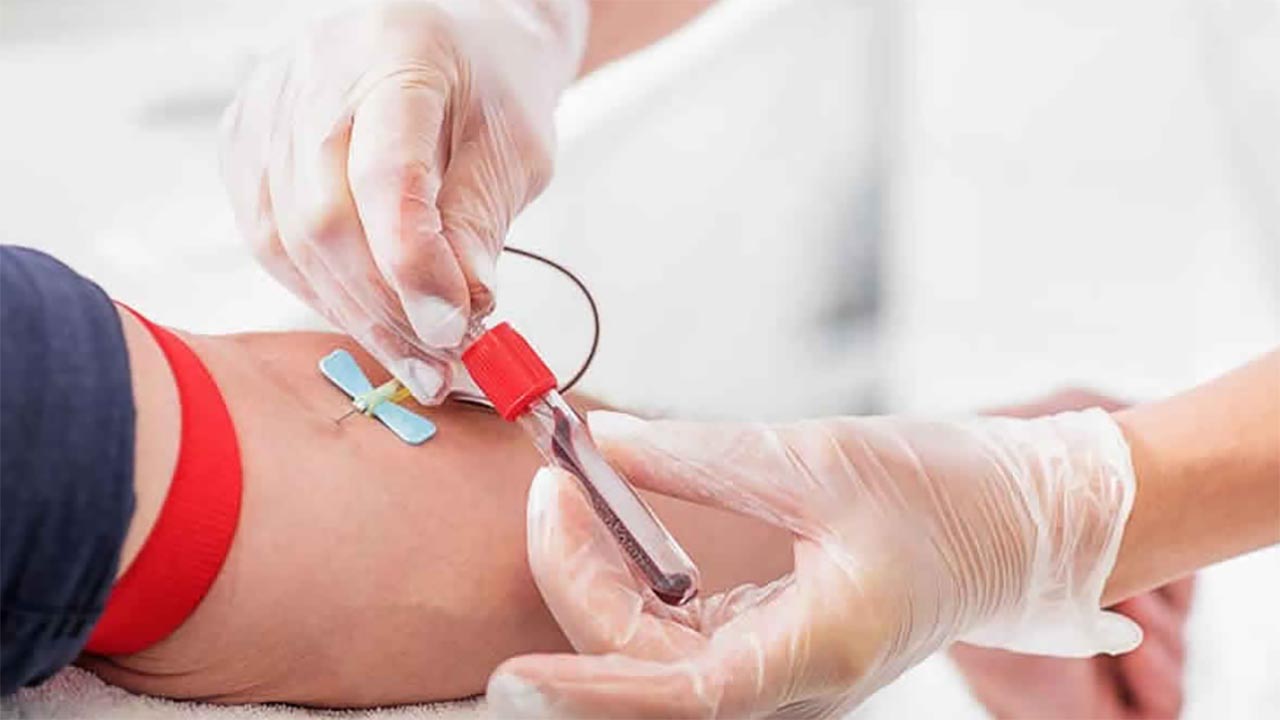 Benarkah Bloodletting Efektif? Mengungkap Mitos dan Fakta di Balik Praktik Pengobatan Kuno Ini