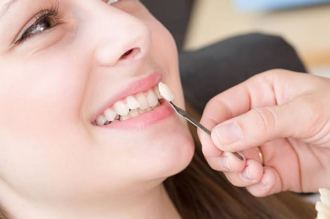 Ngga Perlu Pakai Behel, Berikut Adalah Cara Merapikan Gigi yang Berantakan