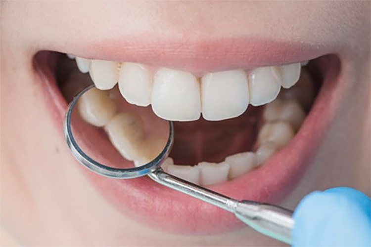 Tak Perlu Mahal, Begini Cara-cara Menghilangkan Karang Gigi, Dijamin Langsung Rontok 