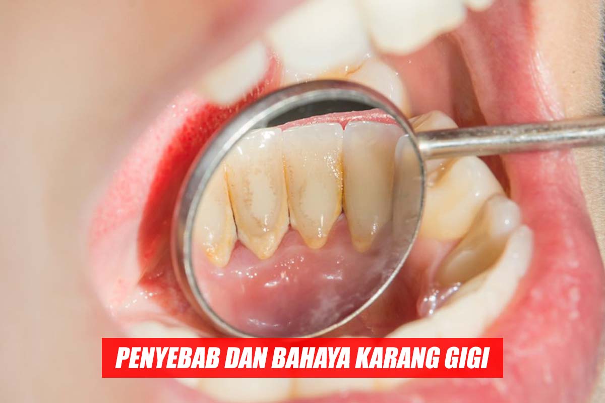 Inilah Penyebab Karang Gigi dan Dampaknya Bagi Kesehatan Mulut