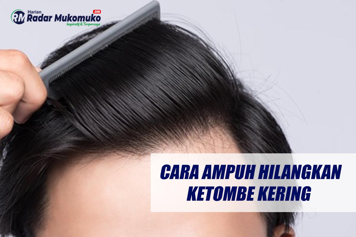 Dijamin Ampuh! Begini Cara Ampuh Hilangkan Ketombe Kering yang Membandel