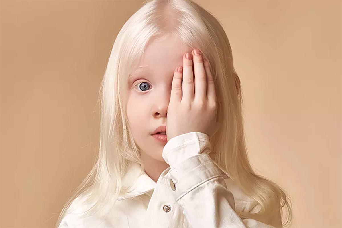 Punya Kulit Putih Bak Bule, Inilah Penyebab Albino Pada Orang dan Jenis-jenisnya