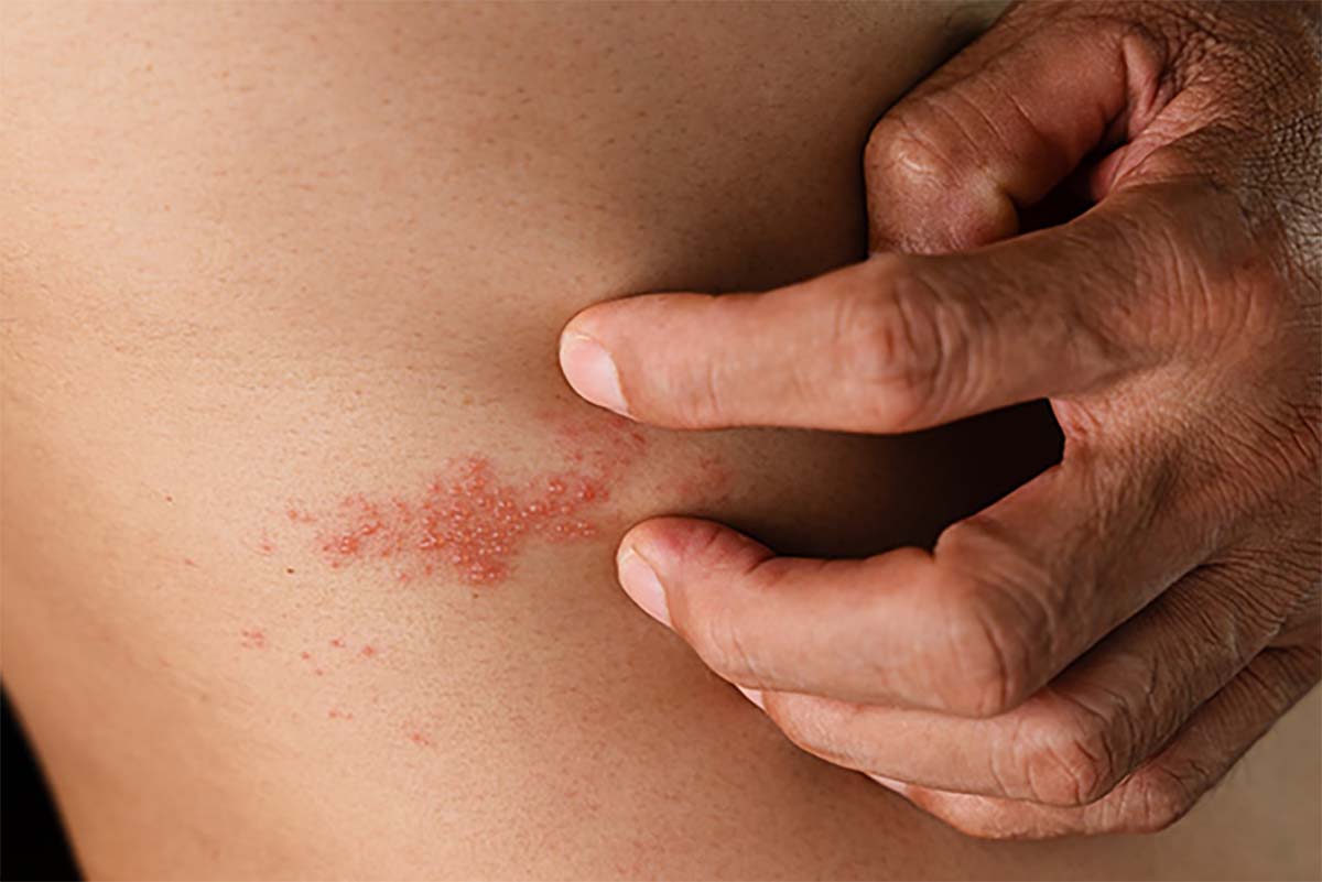 Punya Bekas Luka Herpes yang Menghitam Bikin Tidak PD? Begini Cara Membantu Menghilangkan Bekas Luka Herpes