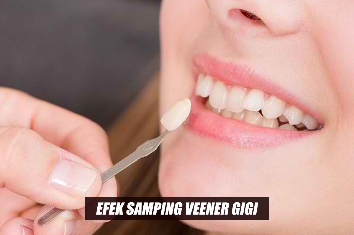 Mau Pasang Veener Gigi? Simak Dulu Efek Sampingnya Sebelum Menggunakannya