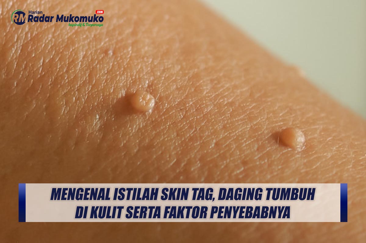 Mengenal Istilah Skin Tag, Daging Tumbuh di Kulit serta Faktor Penyebabnya