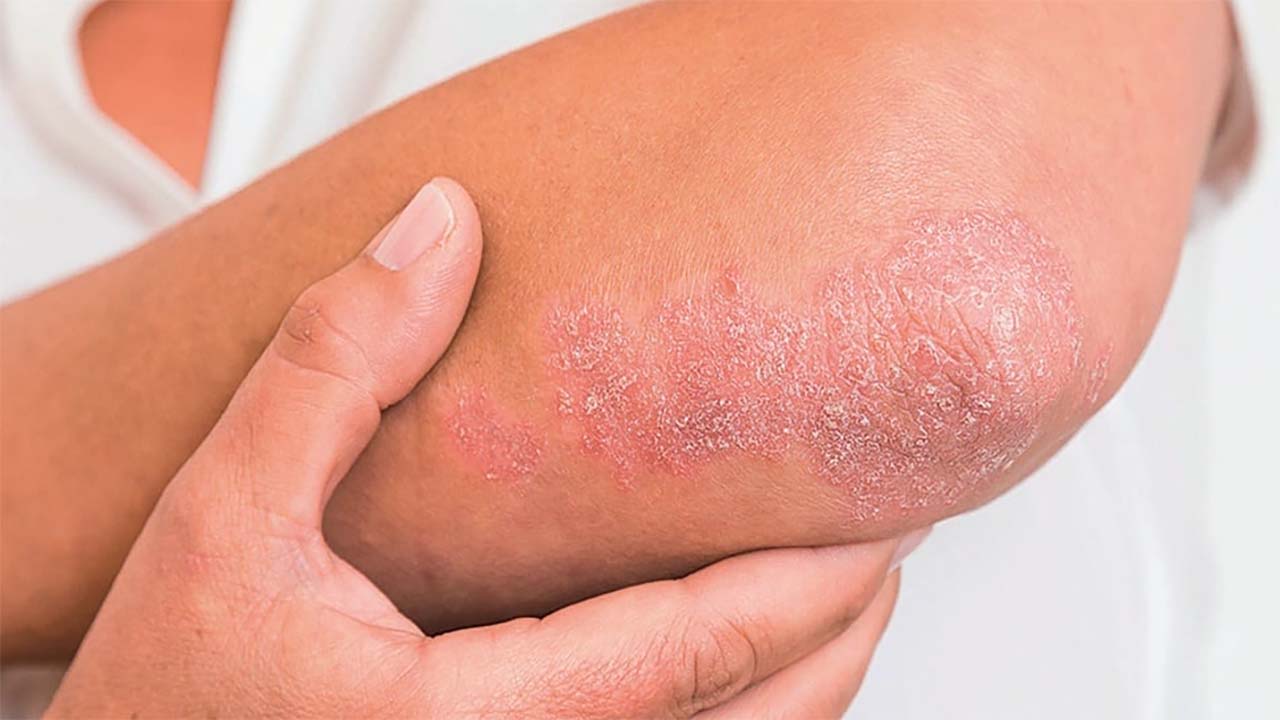 Kelainan Proses Regenerasi Kulit, Inilah Penyakit Psoriasis