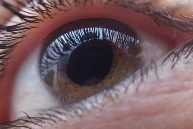 Hati-hati dengan Pencuri Penglihatan! Mari Kenali Penyakit Glaukoma dan Penyebabnya 