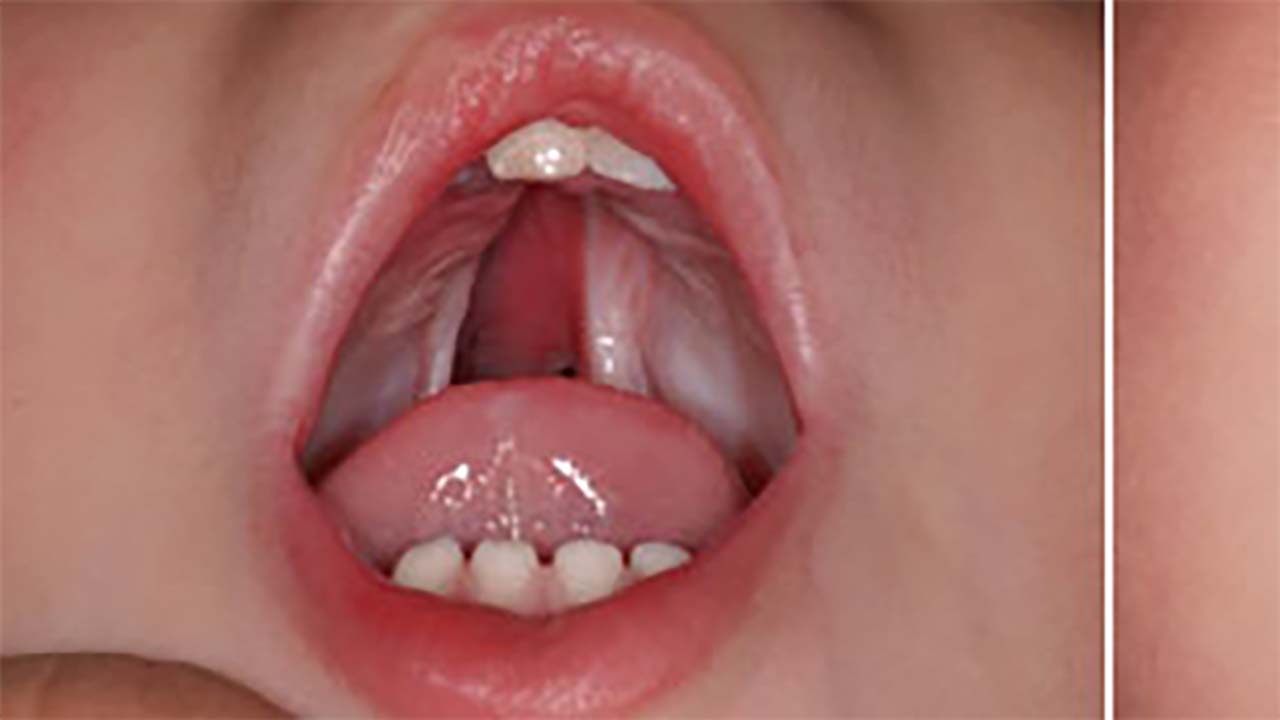 Mengenal Kondisi Cleft Palate, Penyebab dan Cara Mengatasinya