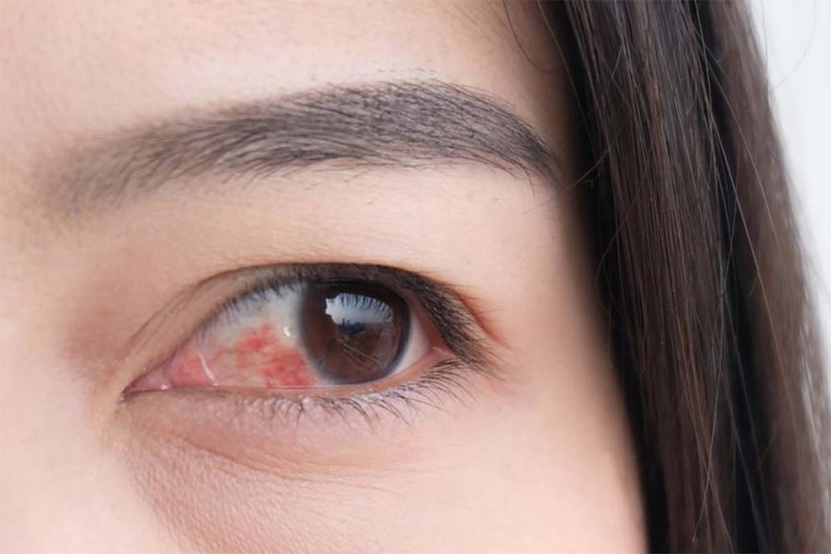 Jangan Anggap Sepele, Ini 5 Gejala Umum Sakit Mata yang Harus Diwaspadai
