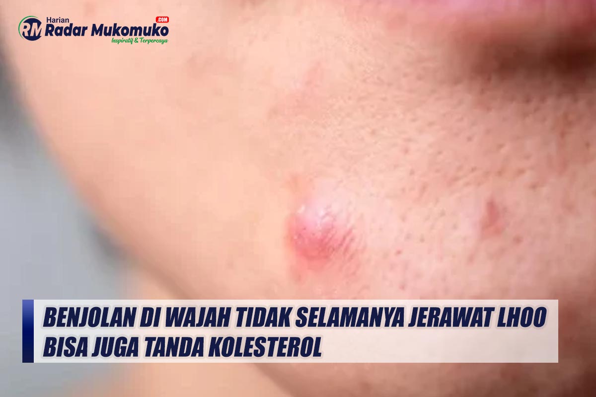 Punya Benjolan di Wajah Tidak Selamanya Jerawat Lhoo Bisa Juga Tanda Kolesterol, Simak Tandanya Berikut Ini