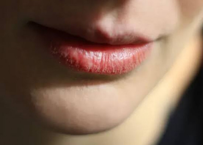 Bibir Mengelupas saat Puasa? Tips Cara Menjaga Kesehatan Bibir Selama Bulan Ramadhan