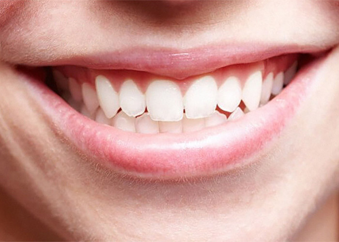 Gak Harus Ke Dokter Gigi, Hanya Menggunakan 2 Bahan Dapur Ini Karang Gigi Rontok Seketika 