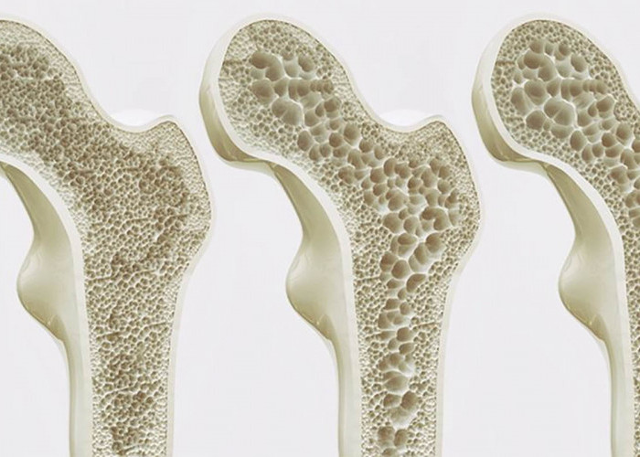 Awas Jangan Salah Paham, Inilah Perbedaan Pengapuran Tulang dan Pengeroposan Tulang yang Perlu Diketahui