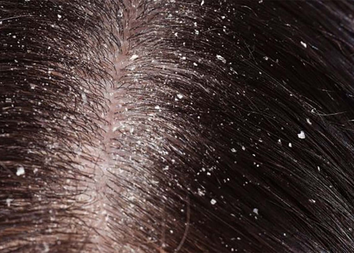 Ternyata Ini Penyebab Ketombe Pada Rambut yang Susah Hilang, Penyebabnya Jarang Disadari