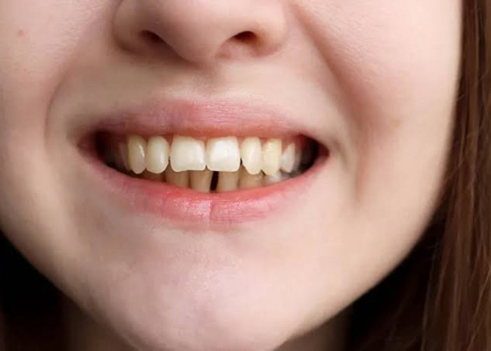 Faktor yang Membuat Bentuk Gigi Berubah Maju ke Depan