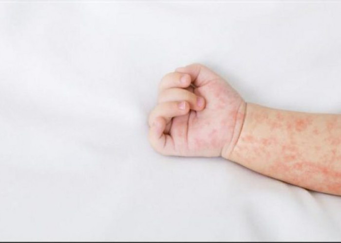 Orang Tua Harus Paham Tanda-Tanda Campak, Segera Ambil Tindakan