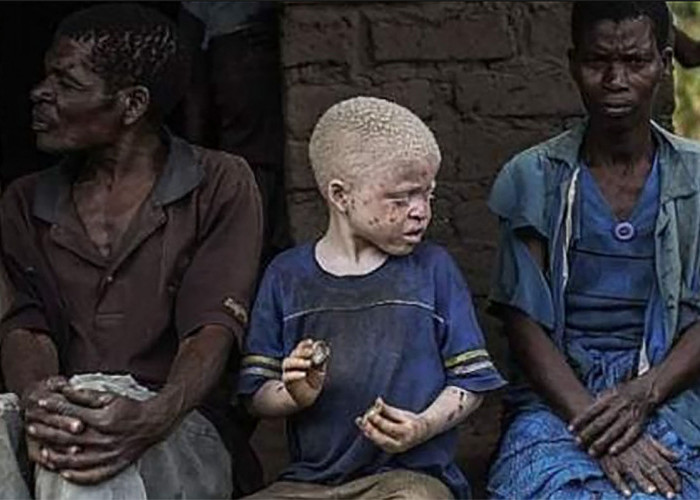 Warga Asli Afrika Berkulit Putih Pucat Dianggap Aneh, Diburu Hingga Organnya Dijual