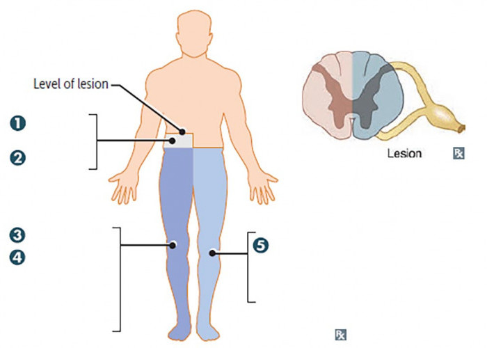 Mengenal Kondisi Syndrom Brown-Sequard Kondisi Cidera pada Posisi Tulang Belakang