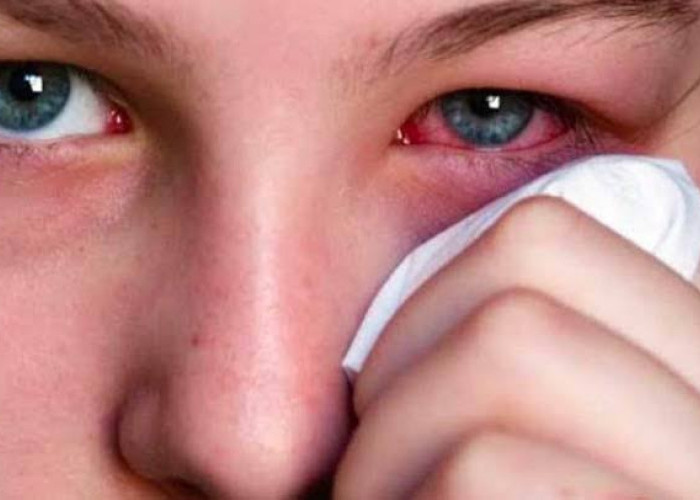 Apa dan Bagaimana Cara Mengatasi Mata Merah?? Berikut 5 Penyebab Mata Merah dan Cara Mengatasinya