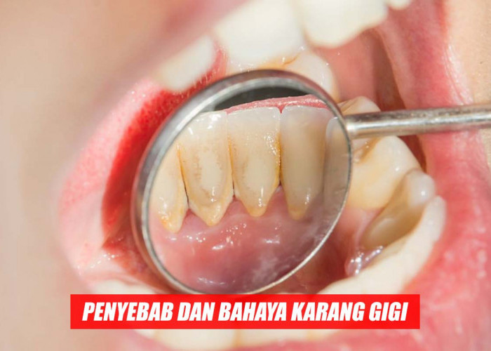 Inilah Penyebab Karang Gigi dan Dampaknya Bagi Kesehatan Mulut