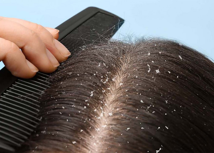 5 Cara Mengatasi Ketombe Pada rambut yang Efektif dan Mudah Dilakukan