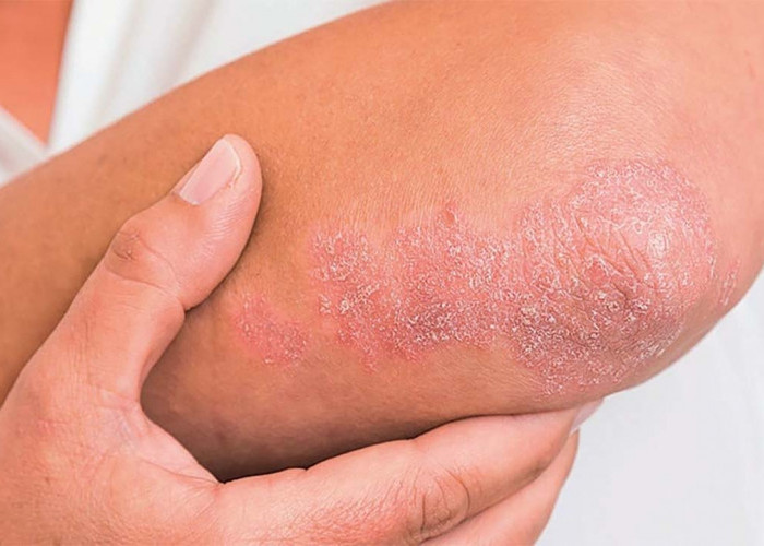 Kelainan Proses Regenerasi Kulit, Inilah Penyakit Psoriasis