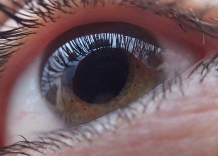 Hati-hati dengan Pencuri Penglihatan! Mari Kenali Penyakit Glaukoma dan Penyebabnya 