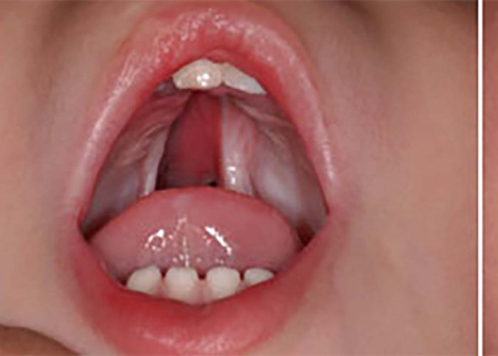 Mengenal Kondisi Cleft Palate, Penyebab dan Cara Mengatasinya