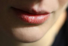 Penyebab Bibir Pecah-Pecah Menurut Dokter