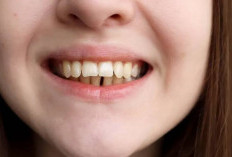 Faktor yang Membuat Bentuk Gigi Berubah Maju ke Depan