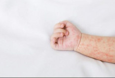 Orang Tua Harus Paham Tanda-Tanda Campak, Segera Ambil Tindakan