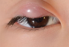 Bukan Karena Sering Ngintip, Ini Penyebab Mata Bintitan