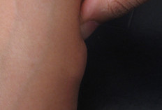 Penyebab Lipom Bisa Tumbuh pada Tubuh Kita